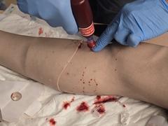 Bohrer am Bein in Nahaufnahme